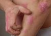 New wearable sensor can quantifies itch