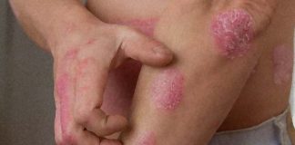 New wearable sensor can quantifies itch