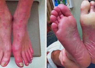 The exercise promotes growth of new small blood vessels to their muscles of people with PAD