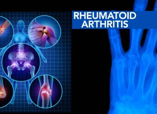 Human Leukocyte antigen (HLA)-DR4 cause an increased susceptibility to rheumatoid arthritis