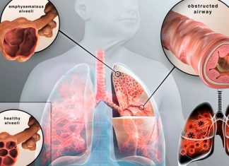 COPD: total mucin concentrations in the lungs could be used as diagnostic markers