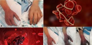 How can inflammation caused by COVID-19 lead to upper limb blood clots and how best to treat them?