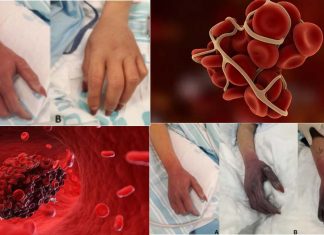 How can inflammation caused by COVID-19 lead to upper limb blood clots and how best to treat them?
