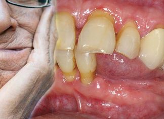 Gli anziani con più denti naturali sono in grado di svolgere meglio le attività quotidiane