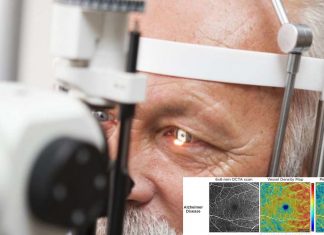 Retinal scans can provide an early sign of Alzheimer’s disease