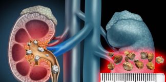 How do kidney stones form and can they be prevented ?