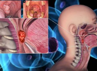 Il sesso orale aiuta ad alimentare più casi di cancro alla bocca e alla gola negli uomini