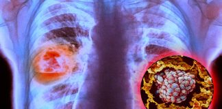 Lung tumors: The new drug Sotorasib reduces tumor size