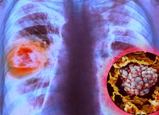 Lung tumors: The new drug Sotorasib reduces tumor size