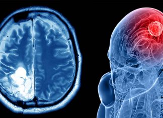 MicroRNAs in urine could be a biomarker to diagnose brain tumors