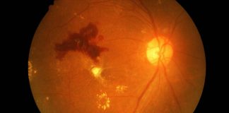 Researchers have developed a synthetic antibody to treat diabetic retinopathy