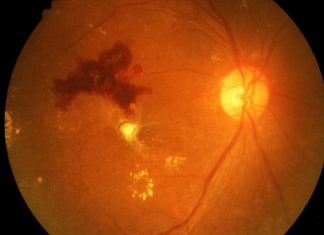 Researchers have developed a synthetic antibody to treat diabetic retinopathy