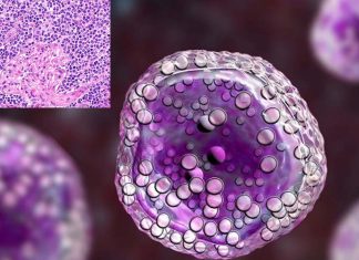 The efficacy of Loncastuximab tesirine to treat aggressive B-cell lymphoma