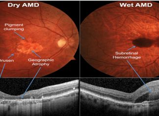 Failure of FHR proteins causes most common form of adult blindness
