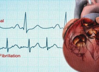 Researchers identifies risk factors for major atrial fibrillation outcomes