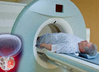 Prostate-cancer: MRI and targeted biopsies could potentially cut overdiagnoses by half