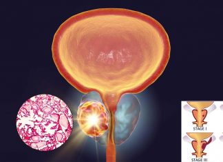 Anti-androgen treatment can facilitate prostate cancer cells to adapt and grow in the bone tumor microenvironment