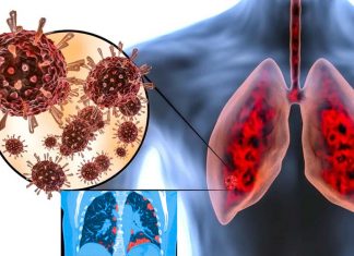 COVID-19: Study Warns Lung Damage Continues In The Recovered