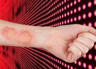 Light therapy may accelerate the healing of burns