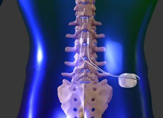 Spinal cord stimulation may drastically reduce chronic back pain