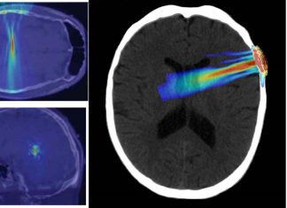 Transcranial focused ultrasound could be used to treat forms of chronic pain