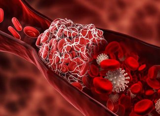 COVID-19: I fluidificanti del sangue hanno ridotto il rischio di ospedalizzazione del 43%