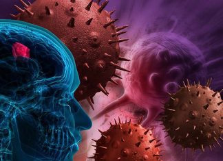 Glioblastoma: i neutrofili vengono mobilitati dal tumore stesso diventando pro-cancerosi