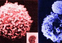 Natural killer cells (NK cells) play an important role in immune surveillance against tumors