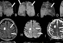 MRI scans revealed that 57.9% of severe SARS-CoV-2 infected patients had recent brain lesions