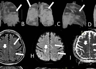 MRI scans revealed that 57.9% of severe SARS-CoV-2 infected patients had recent brain lesions