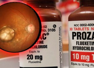 Il Prozac potrebbe offrire il primo trattamento contro la degenerazione maculare atrofica legata all’età