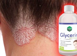 La glicerina è efficace nel combattere la psoriasi