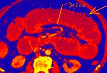 Covid-19 can cause bowel ischemia in asymptomatic patients with persistently negative swab