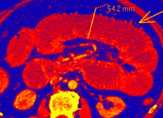Covid-19 can cause bowel ischemia in asymptomatic patients with persistently negative swab