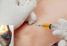 Injections of platelet-rich plasma are no better than placebo for helping reduce knee pain in people with knee joint osteoarthritis