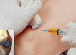 Injections of platelet-rich plasma are no better than placebo for helping reduce knee pain in people with knee joint osteoarthritis