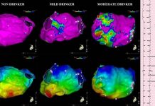 Alcohol use is associated with multiple episodes of cardiac arrhythmia