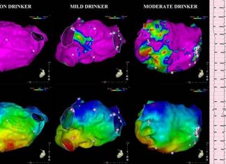 Alcohol use is associated with multiple episodes of cardiac arrhythmia