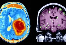 Treatment with arginine enhance the effectiveness of radiation therapy in cancer patients with brain metastases