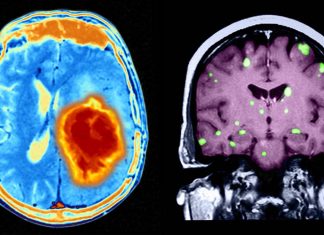 Treatment with arginine enhance the effectiveness of radiation therapy in cancer patients with brain metastases
