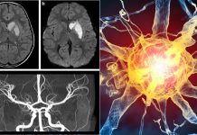 Teenagers infected with COVID-19 can develop CNS autoimmunity after recovery
