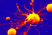 CD1c+ dendritic cells can cause rheumatoid arthritis (RA)