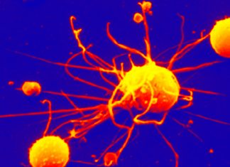 CD1c+ dendritic cells can cause rheumatoid arthritis (RA)