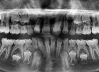 The thickness of growth marks in primary teeth may help identify children at risk for mental health disorders