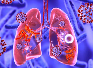 COVID-19 sta riattivando la tubercolosi dormiente negli individui, compresi i bambini