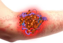 The skin is the Ground Zero for allergic disease
