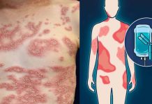 Spesolimab significantly improves signs and symptoms of generalized pustular psoriasis