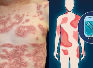 Spesolimab significantly improves signs and symptoms of generalized pustular psoriasis