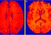 APOE4 allele gene more than doubles risk of severe COVID-19 and cerebral microhemorrhages