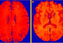 APOE4 allele gene more than doubles risk of severe COVID-19 and cerebral microhemorrhages
